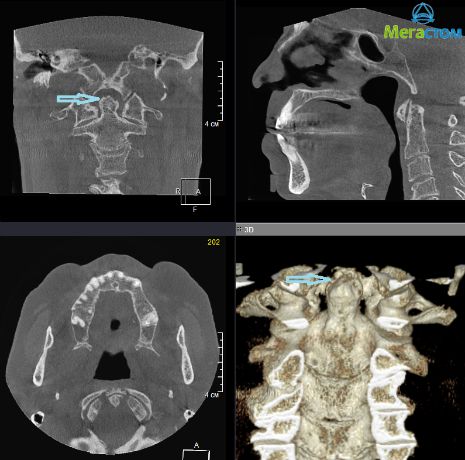 3D-компьютерная рентгендиагностика при заболеваниях ВНЧС, восстановление разрушенной коронки зуба