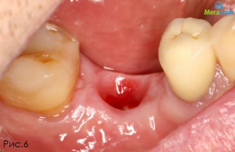 До лечения, после удаления зуба сразу ставят имплант