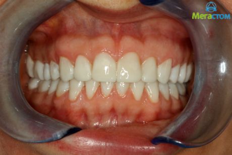 Mock-up. После переноса восковой моделировки в полость рта, технология установки виниров в стоматологии
