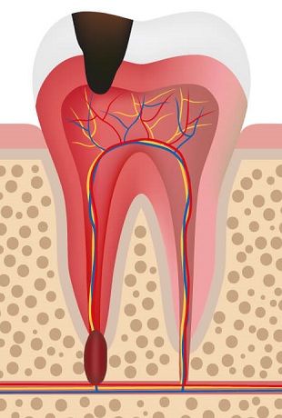 межкорневая киста зуба лечение, методы лечения кисты зуба 