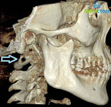 3D-компьютерная рентгендиагностика при заболеваниях ВНЧС, имплантация зубов в Москве цены