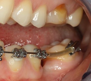 установка частичной брекет-системы, самая лучшая стоматология в москве лингвальные брекеты