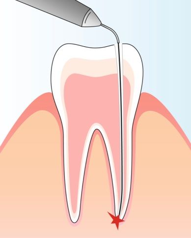 киста зуба лечение лазером, киста зуба лечение лазером цена в москве