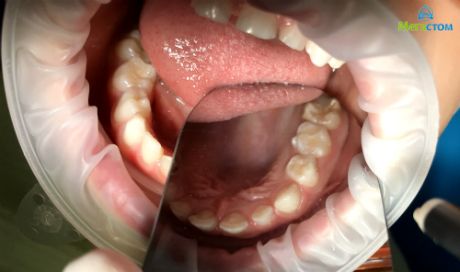 зуб после пломбирования