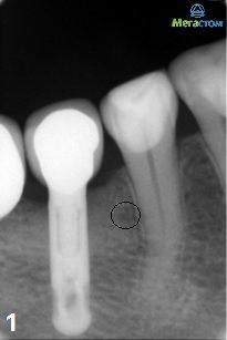 зуб болит после пломбирования каналов
