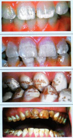 Пораженные флюорозом зубы, профессиональная гигиена полости рта этапы проведения