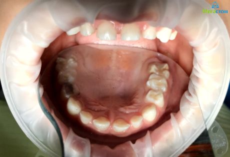 гипоплазия постоянных зубов, пломбирование зубов по классам 
