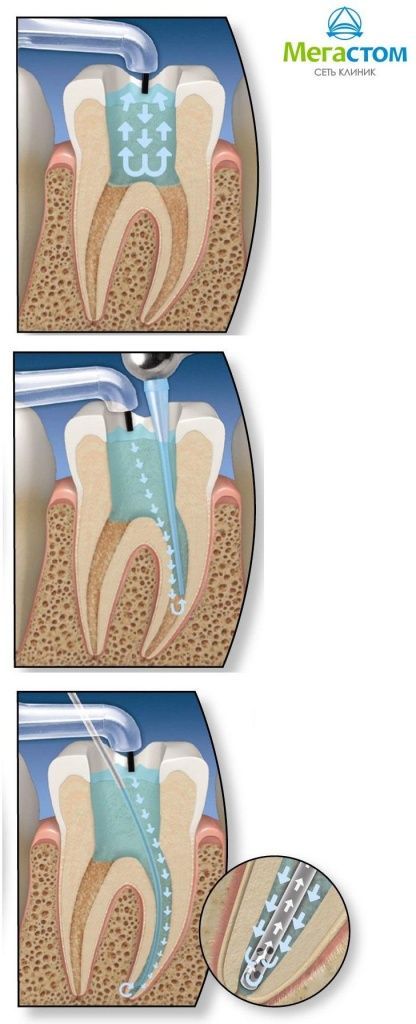 Лечение зубов, лечения корневых каналов