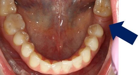 стоимость протезирования зубов на имплантах