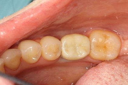 после лечения, зубы после установки коронок