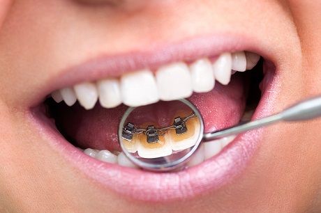 лечение кариеса с брекетами, стоматология протезирование зубов Москва