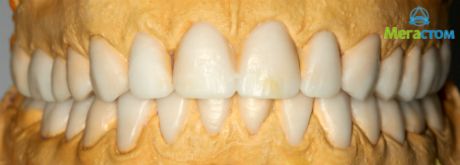 Гипсовые модели с восковой моделировкой зубов, протезирование зубов виды протезов цены