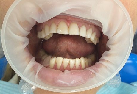 Лечение зубов от кариеса
