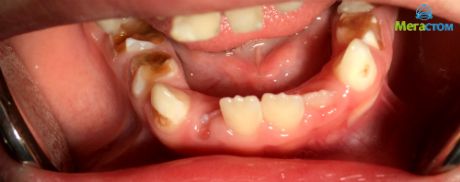 гипоплазия молочных зубов, заболел зуб после пломбирования