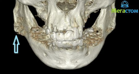 3D-компьютерная рентгендиагностика при заболеваниях ВНЧС