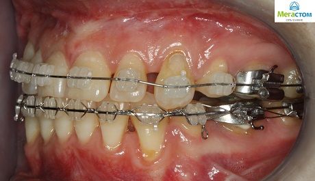 Ортодонтическое лечение комбинированное с ортогнатической коррекцией прикуса