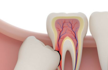 зуб мудрости симптомы лечение, зуб мудрости лечение в домашних условиях