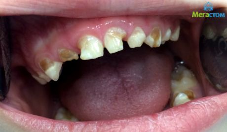 гипоплазия молочных зубов