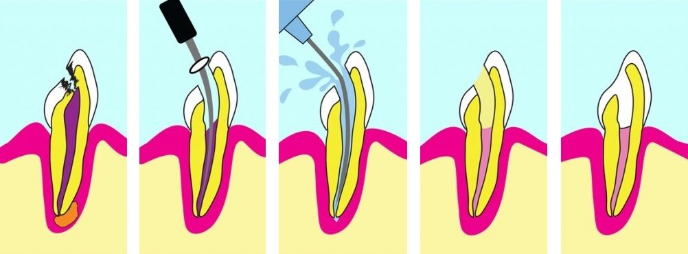 Этапы лечения корневых каналов, зуб болит после пломбирования, болит зуб после пломбирования каналов 