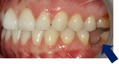 дефицит места для протезирования 36-го зуба