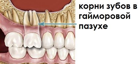 имплантация зубов под ключ что это, имплантация зубов без наращивания костной ткани