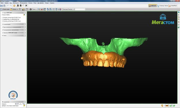 3D-моделирование имплантации 