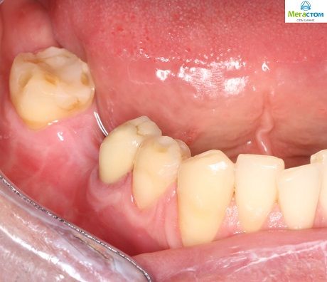 до лечения, зубное протезирование при частичном отсутствии зубов