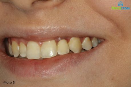 после лечения, протезирование зубов при отсутствии зубов фото