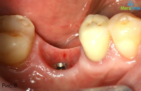 Достигнут желаемый результат в области десневого края, новейшее протезирование зубов и цены