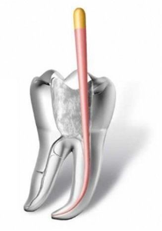 пломбирование зуба штифт, стоматологическое пломбирование канала зуба, пломбирование каналов зуба гуттаперчей