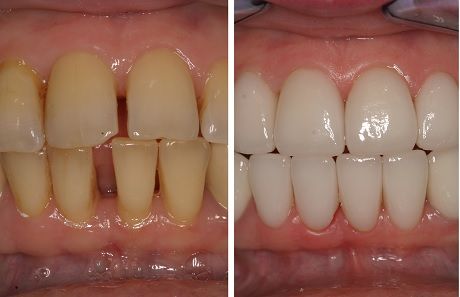 установка виниров на кривые зубы фото до и после