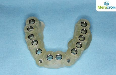 3D-шаблон, удаление зуба и установка импланта в один день