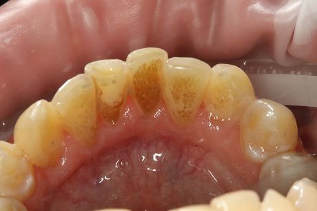 профессиональная гигиена полости рта показания, профилактика и лечение кариеса зубов