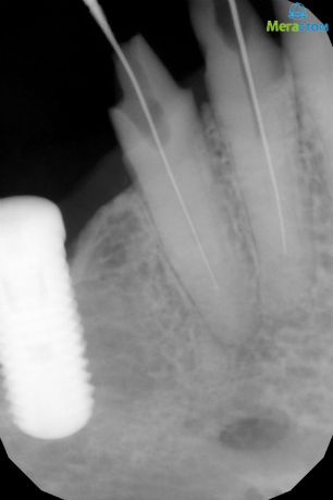 Пломбирование каналов зубов гуттаперчей, лечение зуба пломбирование каналов