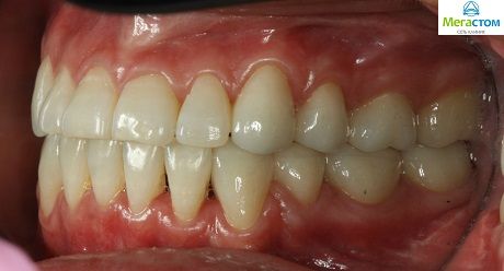 после лечения, протезирование зубов новые технологии цена 