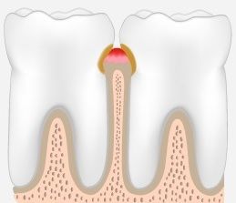 гингивит после установки коронки на зуб возможен в течение 1-2 дней