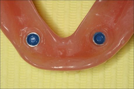 Адаптация протеза для фиксации на локаторах, протезирование зубов при отсутствии зубов на нижней челюсти 