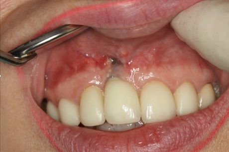 удаление импланта зуба форум, удаление импланта последствия