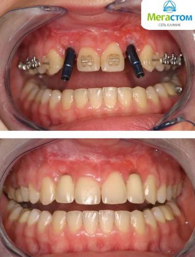 Имплантация зубов без разрезов
