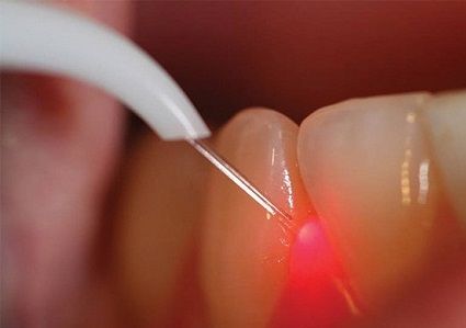 Лазерное лечение десен цена Чистка зубов Air Flow Томск Лесная 2-я