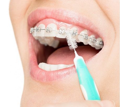 лечение зубов с брекетами кариес
