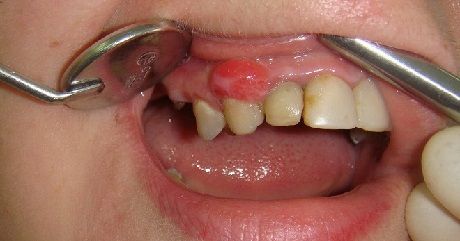 киста зуба симптомы лечение и последствия 