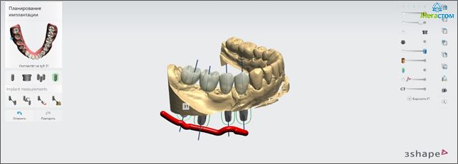 3D планирование операции имплантации