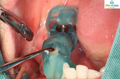 Имплантация с помощью 3D-хирургического шаблона, методы протезирования зубов при отсутствии зуба