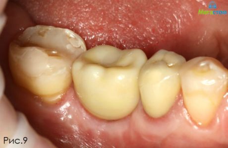 После двух этапов лечения, несъемное протезирование зубов виды и цены