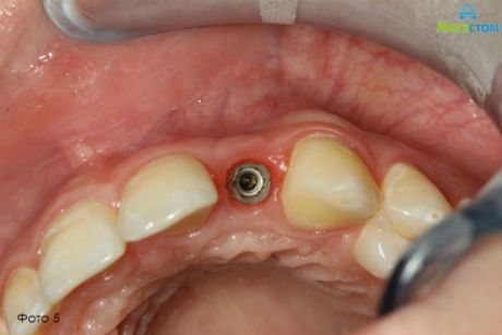 извлечен формирователь десны, протезирование зубов при частичном отсутствии зубов на верхней челюсти
