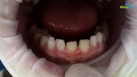 гипоплазия постоянных зубов, пломбирование зубов цены