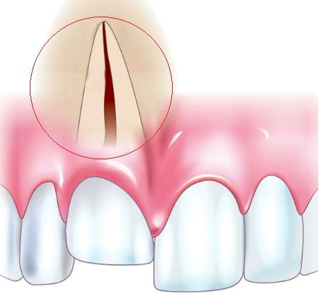 Что делать при травме зуба