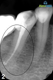 удаление нерва зуба и пломбирование каналов