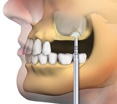 имплантация зубов в Москве цена под ключ, после удаления зуба можно ставить имплант